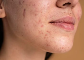 Skin Diseases Skin Diseases
